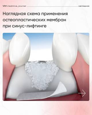 Мембраны «Биопласт-Дент»: схема для синус-лифтинга.